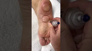 Myofasical sliding cupping for plantar fasciitis