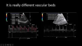 My recent case report about the future treatment of shock by U/S