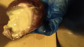 Huge pus filled abscess