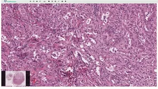 Adenomatoid Tumor - Histopathology