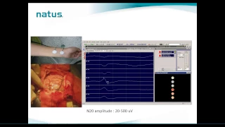 Natus IOM Webinar: Brain Mapping Technique in IOM