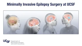 Minimally Invasive Epilepsy Surgery at UCSF | Edward Chang, MD
