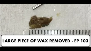 LARGE PIECE OF EAR WAX REMOVED   EP 103