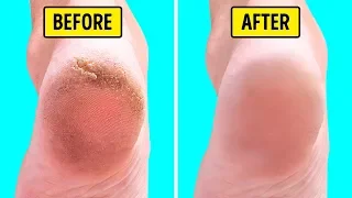 10 Natural Home Remedies for Silky Smooth Feet