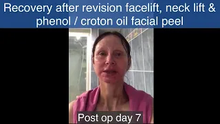 My Video Diary Part 2 | Revision facelift, necklift & facial phenol / croton oil peel | Week 2 - 4