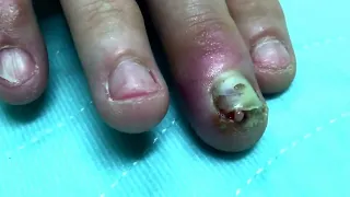 Finger infection Drainage Procedure