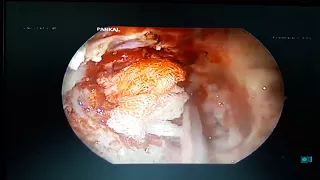 8th time Revision haemangiopericytoma of orbital apex - Dr. Narayanan Janakiram