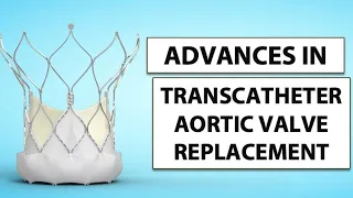 Patient Webinar: Advances in Transcatheter Aortic Valve Replacement (TAVR)