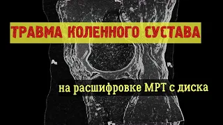 ТРАВМА КОЛЕННОГО СУСТАВА -  повреждение мениска, повреждение связки надколенника на расшифровке МРТ