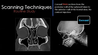 3 Paranasal sinus Imaging - prof.Mamdouh Mahfouz (2019 edition)