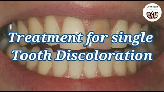 How to whiten a single dark tooth | causes and treatment of single tooth discoloration