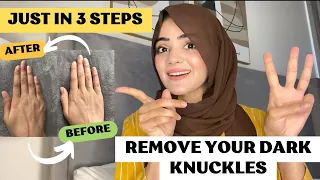 How To Remove Dark Knuckles | Get Rid of Dark Knuckles With Home Remedy | Dietitian Aqsa