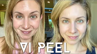 Vi PEEL done at Home | Step by Step Process + Before and Afters
