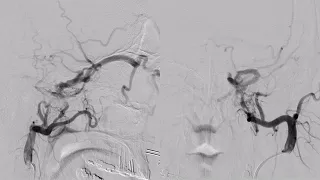 Carotid Cavernous Fistula - Embolization