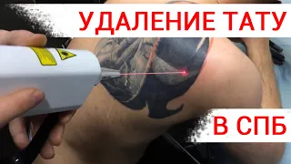 Лазерное удаление татуировки в Пушкине и СПб