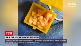 Новини України: для чого стоматологи з Київської області видали 9-річній дитині 12 молочних зубів