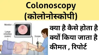Colonoscopy test in Hindi | कोलोनोस्कोपी टेस्ट क्या है | कैसे होता है |