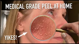 DIY TCA Chemical PEEL 20% | skip2mylou