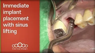 Immediate implant placement with sinus lifting - [Dr. Kim Yongjin]