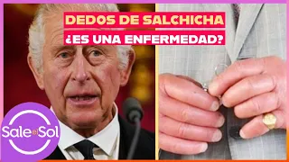 Por qué el rey Carlos III tiene dedos de salchicha | Visita de Doctor | Sale el Sol