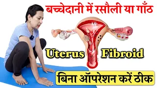 बच्चेदानी में गाँठ या रसौली बिना ऑपरेशन करें ठीक | Uterus Fibroid Treatment Without Surgery