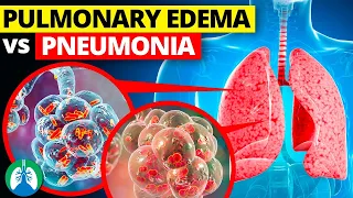 Pulmonary Edema vs. Pneumonia