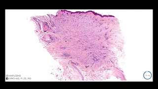 Morpheic Basal Cell Carcinoma explained by a dermatopathologist. Dermpath made easy: Unknown #9