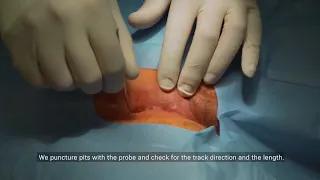 SMILE technique for Pilonidal Sinus destruction with a radial laser probe - video vignette