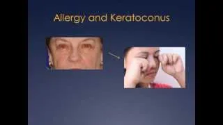 Ocular Allergy and Keratoconus