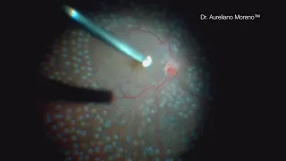 Pattern Endolaser During Vitrectomy In Diabetic Retinopathy | Retina Center Tijuana