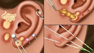 ASMR Satisfying Piercing Pus Removal Animation, Ear Acne Blackhead Extrusion, Sebaceous Cyst