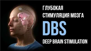 Глубокая стимуляция мозга РНХИ им. проф. А.Л. Поленова / Deep Brain Stimulation (DBS)