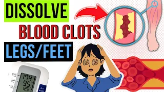 TOP Vitamins To REMOVE Blood Clots |  Causes,TIPS & Nutrients