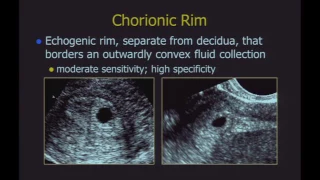 Ultrasound of Failed First Trimester Pregnancies and Ectopic Pregnancies