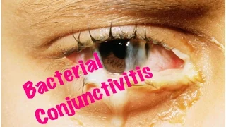 Medical Video Lecture Ophthalmology: Bacterial Conjunctivitis Made simple