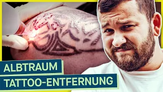 Undercover Tattoo-Entfernung: So viel kann schief gehen!