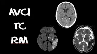 Videoaula e dicas em RADIOLOGIA: AVCI na TC e RM