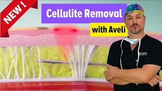 Aveli Cellulite Reduction