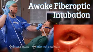 Awake Fiberoptic Intubation