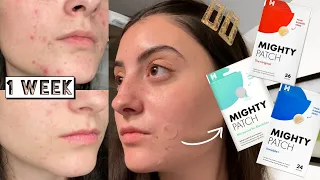 TESTING HERO MIGHTY PATCH & MICRO POINT ACNE PATCHES ON MY HORMONAL ACNE FOR 1 WEEK