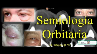 Semiología Orbitaria.