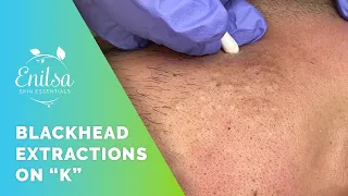 Blackhead Extrations on "K" - He's back!