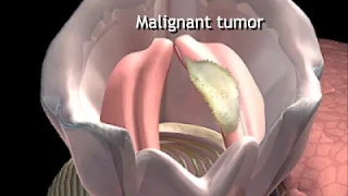 What Causes Vocal Cord Cancer Animation - Malignant Tumors of Throat or Larynx Video