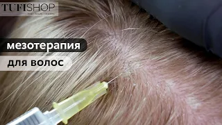 Мезотерапия для волос| Лечение | Против выпадения| Для роста| Советы врача- косметолога