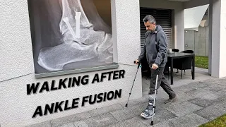 Walking After Ankle Fusion