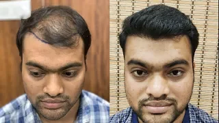 Hair Transplant In India | Hair Transplant Results