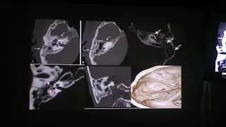 د/ شريف عبد الغتاح مدرس الاسعة طب المنصورة  Temporal bone Trauma  Imaging