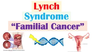 Lynch Syndrome (Hereditary Non-Polyposis Colorectal Cancer) Genetics, Symptoms, Diagnosis, Treatment