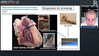 How To Do Left Bundle Branch Pacing