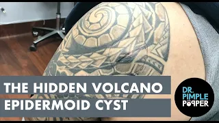 The Hidden Volcano Cyst